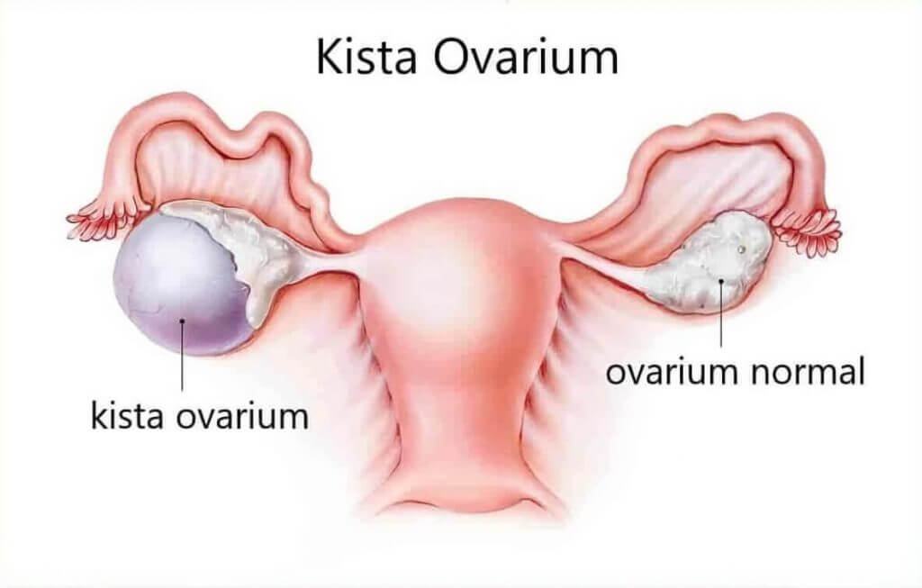 MENGENAL 9 PENYAKIT KISTA MENGENAL 9 PENYAKIT KISTA
