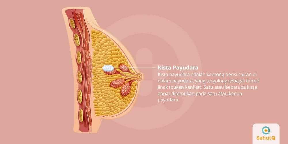 MENGENAL 9 PENYAKIT KISTA MENGENAL 9 PENYAKIT KISTA